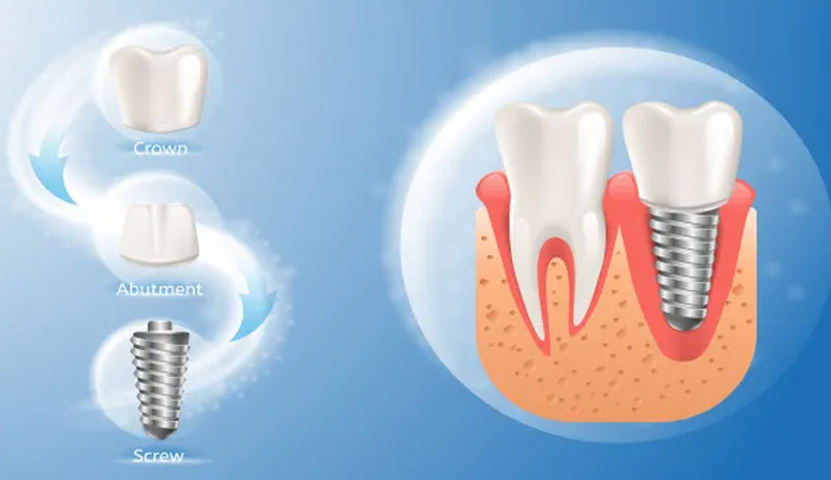 Dental Implants in Al Ain