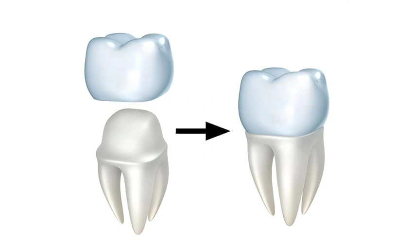 Dental Crowns in Al Ain