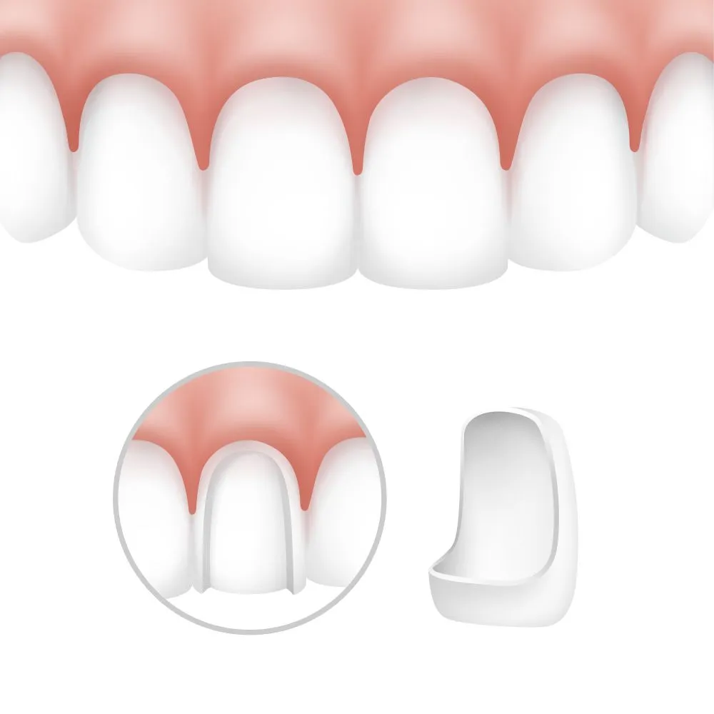 Veneers in Al Ain