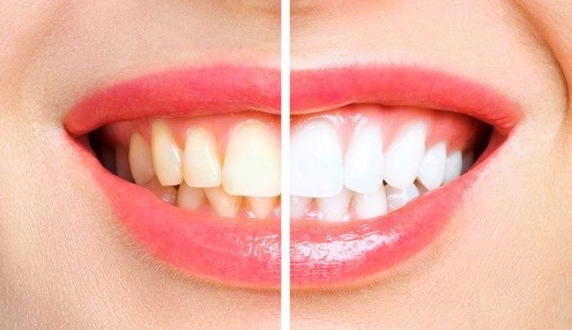 Teeth Whitening in Al Ain
