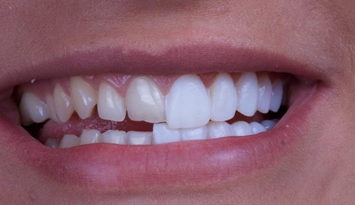 Veneers in Al Ain