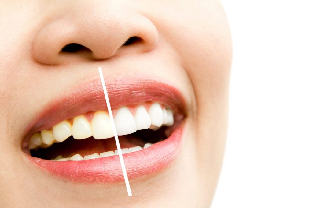 dentist in Al Ain fixes yellow teeth
